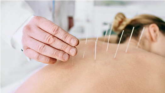 Acupuncture for detox