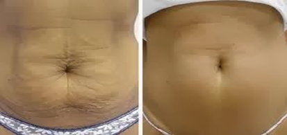 How to tighten the skin after weight loss?