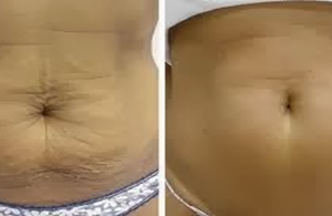 Как да стегнем кожата след отслабване?