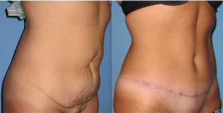 How to tighten the skin after weight loss?